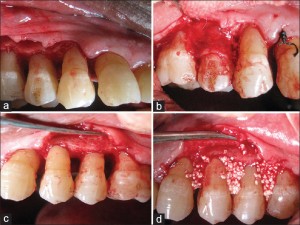 JIndianSocPeriodontol_2015_19_1_61_148639_f1