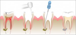 root-canal