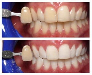 teeth whitening cosmetic dentistry castle hill